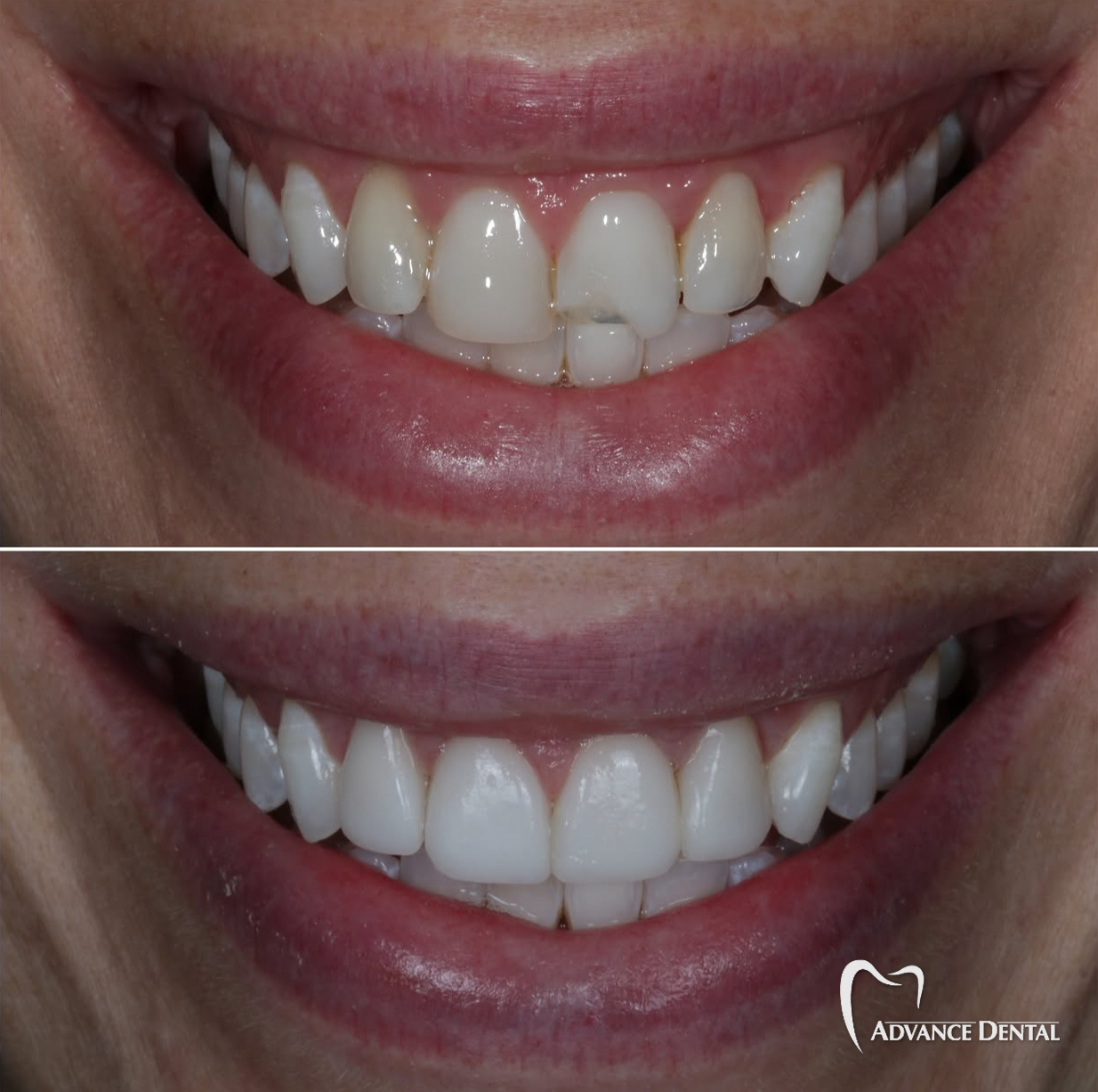 Cosmetic Bonding For A Chipped Front Tooth Before and after cosmetic bonding on a chipped upper front tooth at Advance Dental in Grand Rapids.