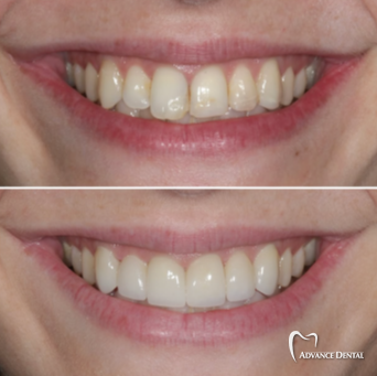 Cosmetic Bonding To Even Out Uneven Front Teeth Before and after cosmetic bonding reshaping uneven front tooth edges.