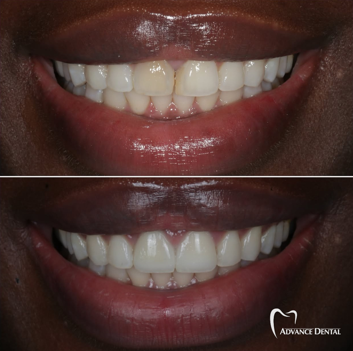 Cosmetic Bonding & Whitening For Uneven Color And Edges Before and after cosmetic bonding and teeth whitening evening out the color and edges of the front teeth.