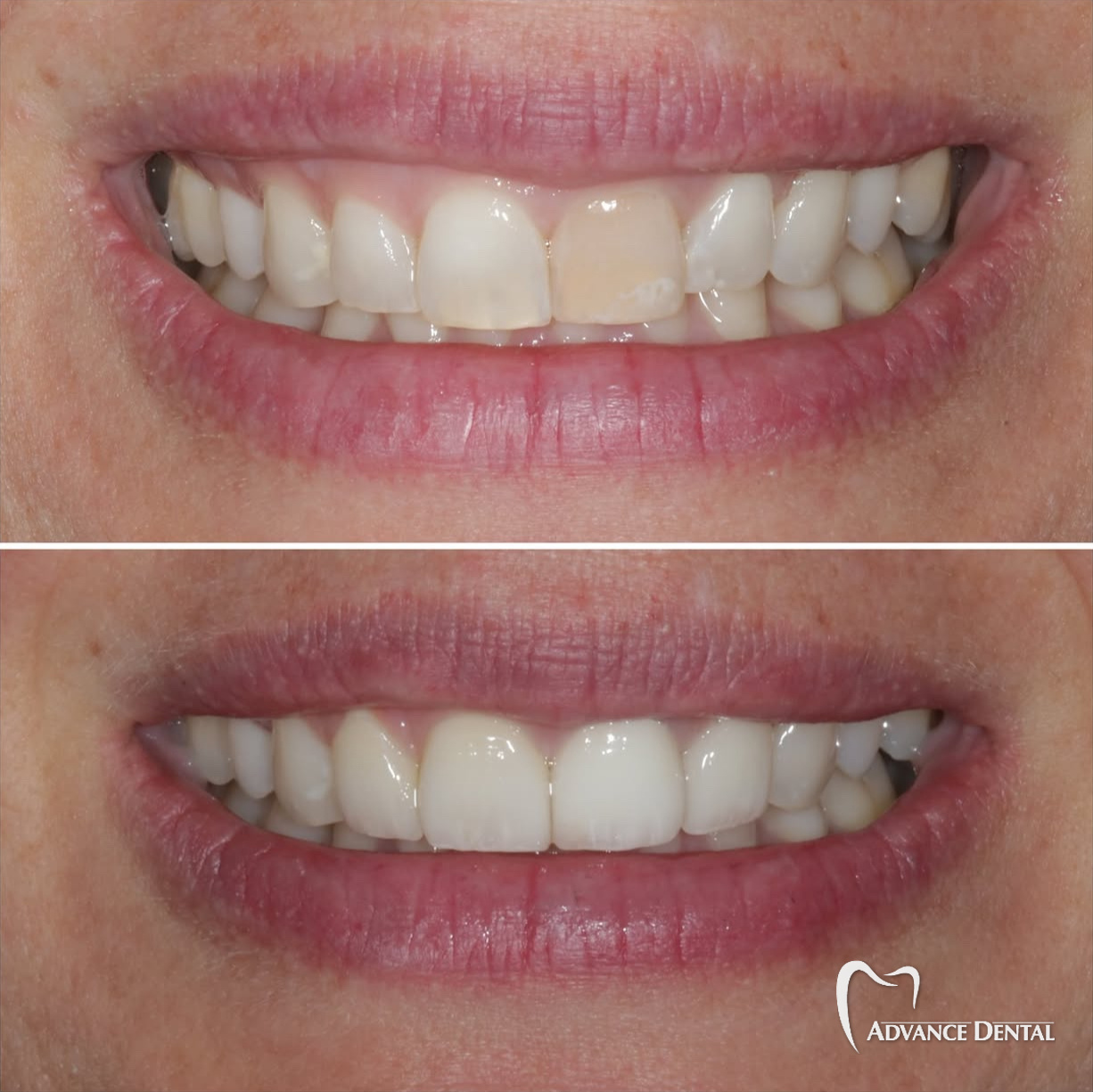 Crown, Bonding & Whitening For Discolored, Uneven Front Teeth Before and after a dental crown, cosmetic bonding and teeth whitening on discolored, uneven front teeth.