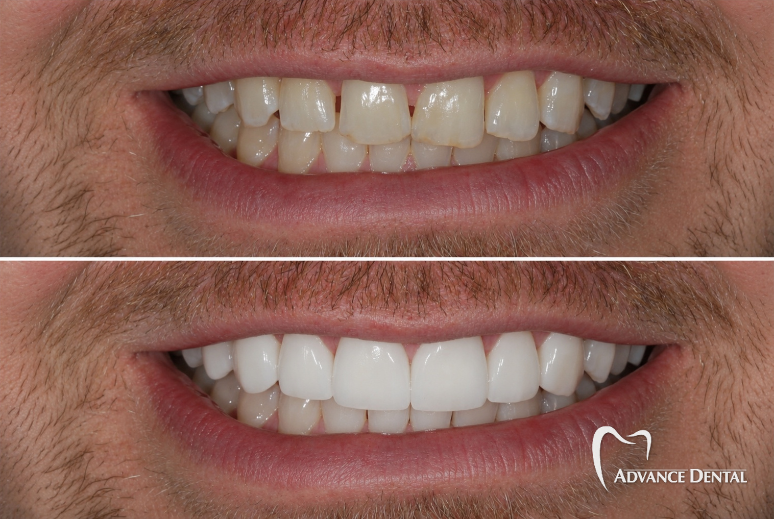 Crowns & Porcelain Veneers For Damaged, Uneven Front Teeth Before and after dental crowns and porcelain veneers rebuilding damaged, uneven front teeth.