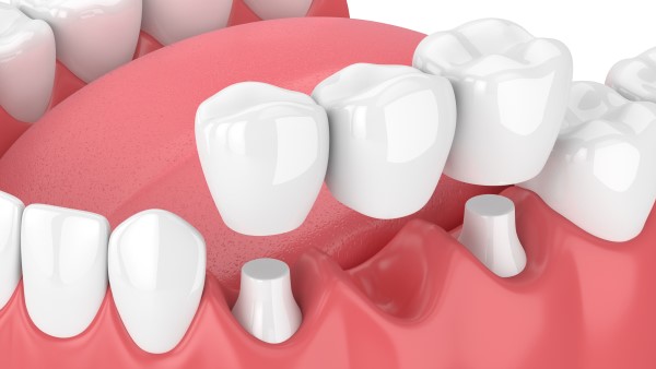 Dental Bridge Diagram