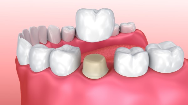 Dental Crown Diagram