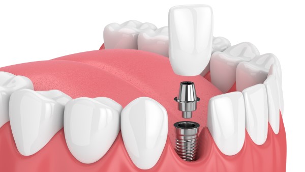 Dental Implant Diagram