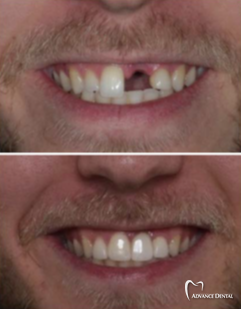 Single Dental Implant For A Missing Front Tooth Before and after a single dental implant replacing a missing upper front tooth at Advance Dental in Grand Rapids.