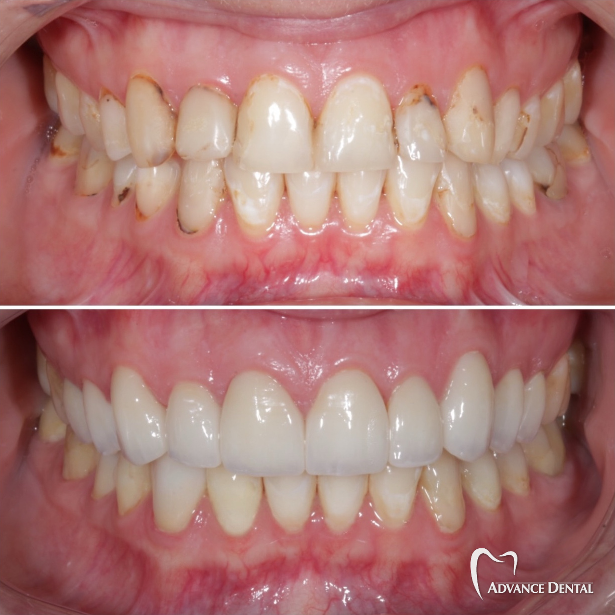 Full Mouth Rehabilitation For Severely Worn And Damaged Teeth Before and after full-mouth rehabilitation rebuilding severely worn and darkened teeth at Advance Dental in Grand Rapids.