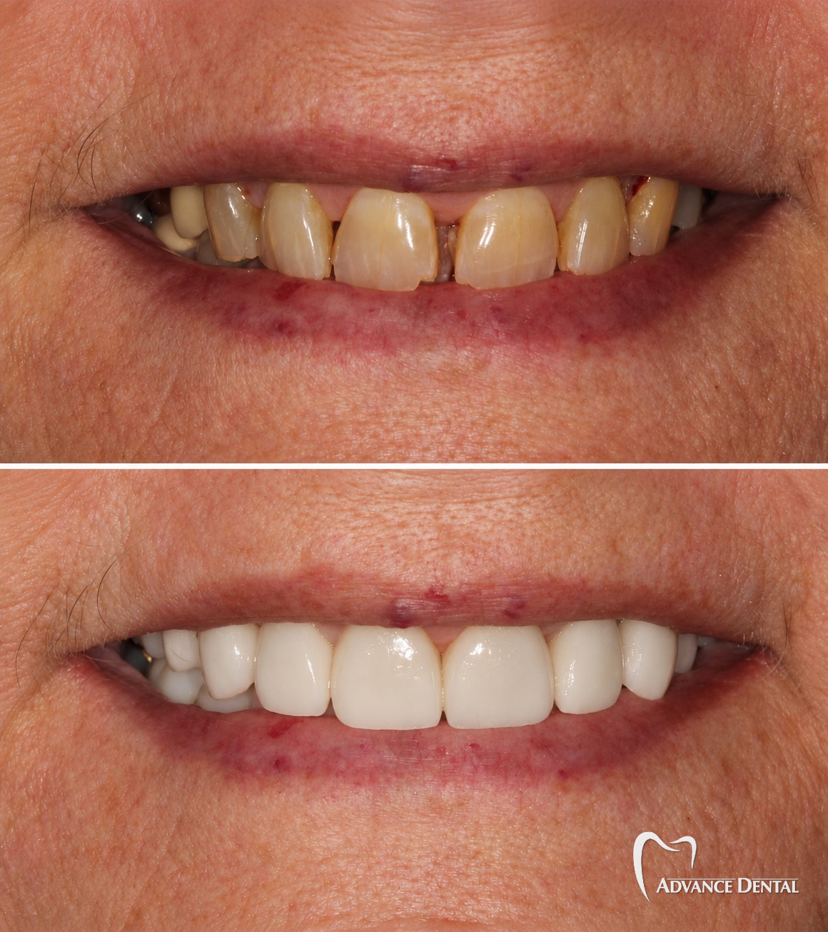 Full Mouth Rehabilitation For Worn And Uneven Teeth Before and after full-mouth rehabilitation restoring worn, darkened and uneven teeth.