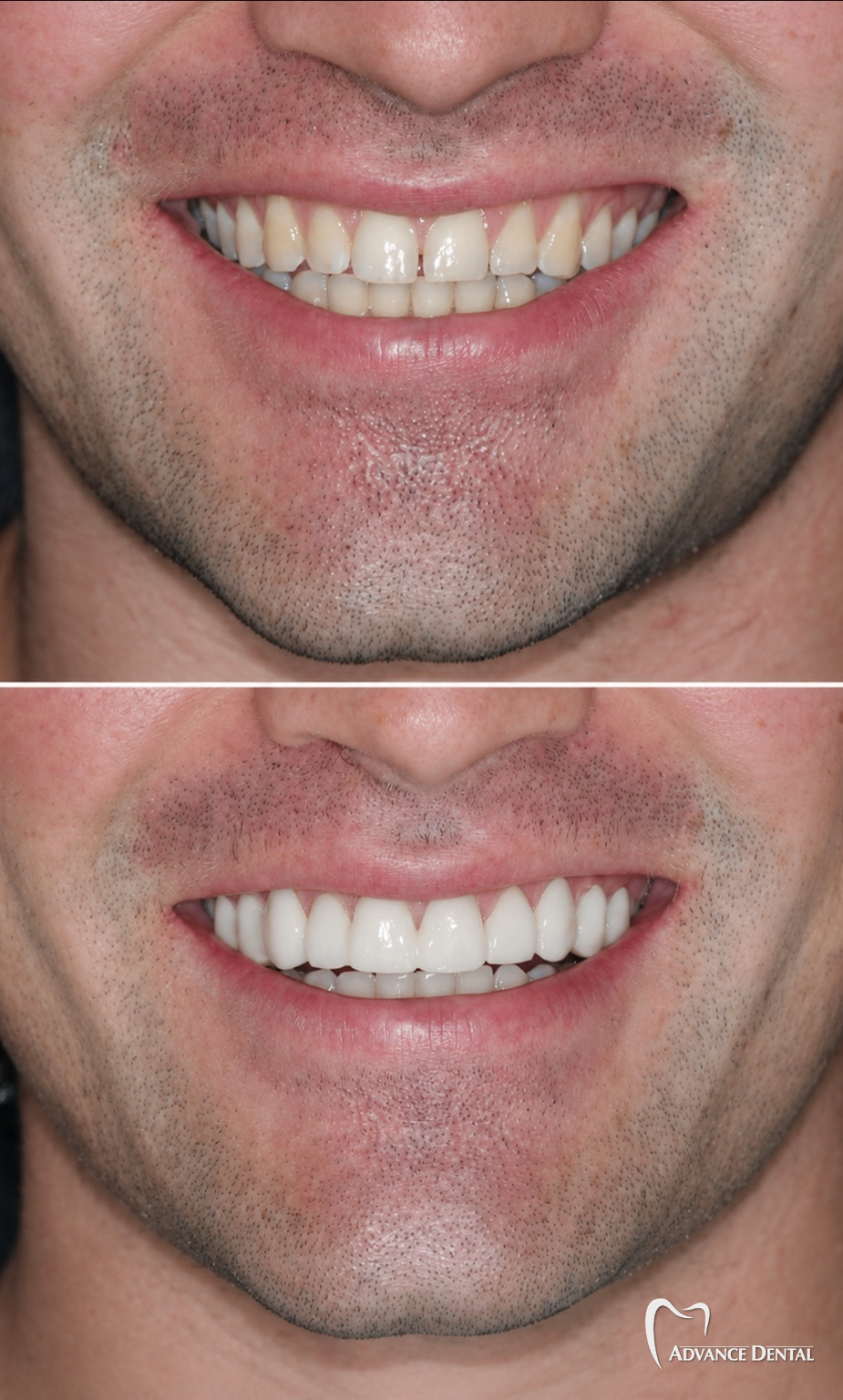 Porcelain Crowns For An Uneven Smile Line Before and after porcelain crowns correcting uneven tooth lengths and an irregular smile line.