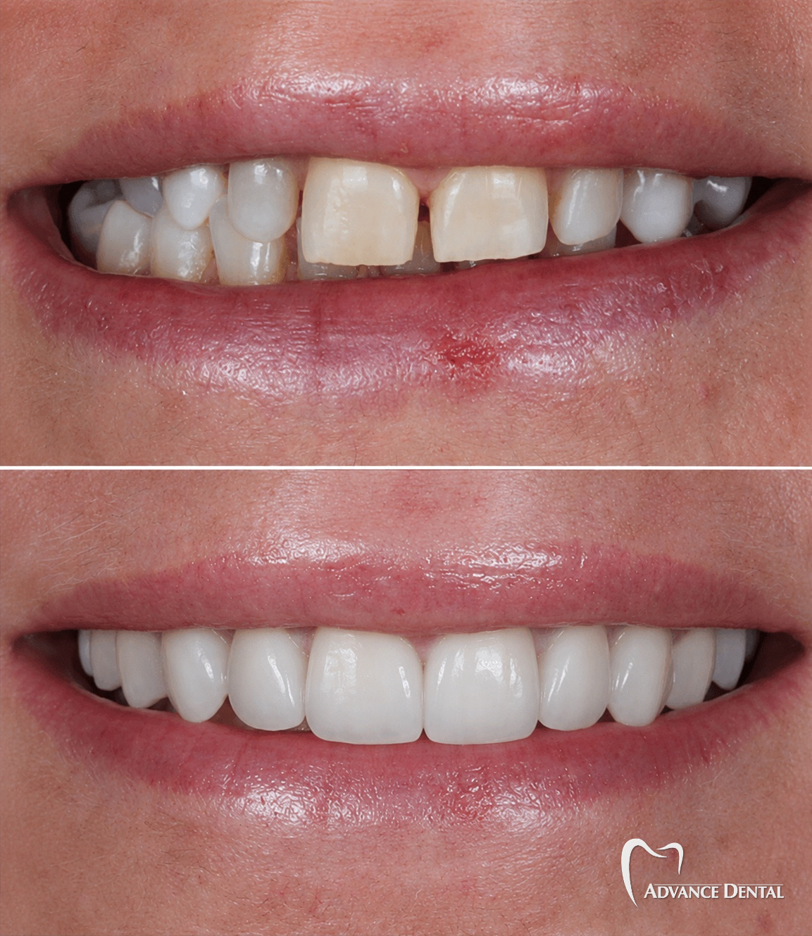 Porcelain Crowns For Worn, Discolored Teeth Before and after porcelain crowns restoring worn, discolored teeth to a fuller length and shade.
