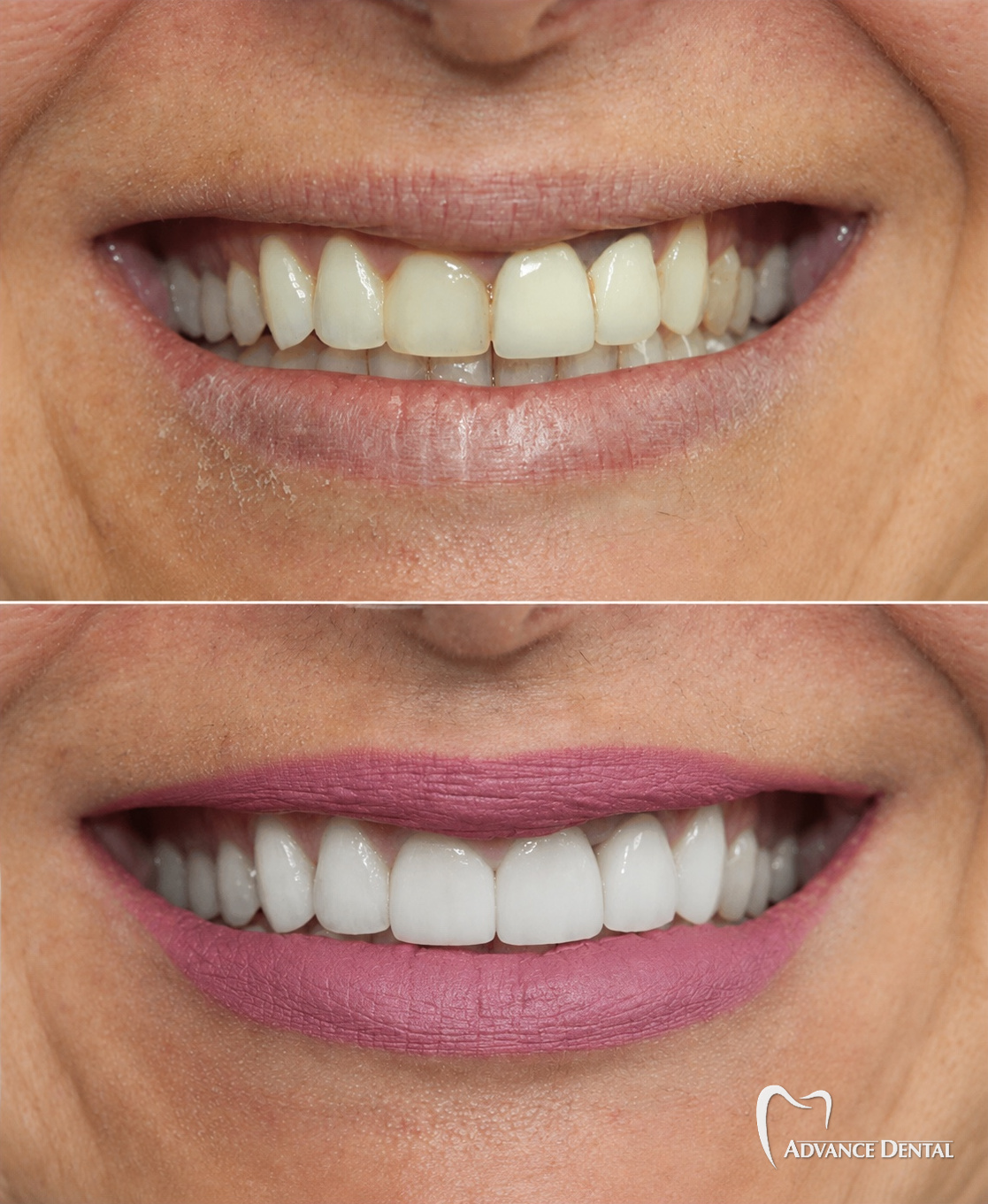 Porcelain Veneers For Uneven Color And Tooth Shape Before and after porcelain veneers correcting uneven color and tooth shape across the upper front teeth.