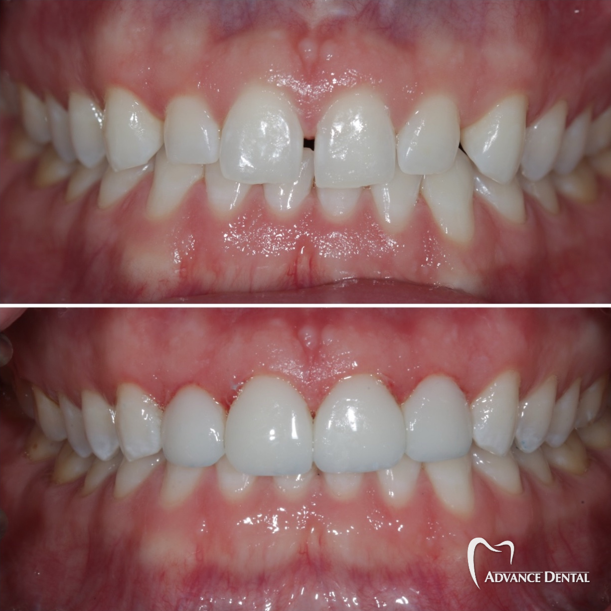 Porcelain Veneers & Whitening To Close Spacing Between Front Teeth Before and after porcelain veneers and teeth whitening closing spacing between the front teeth.